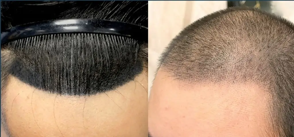 紋髮失敗頭盔頭vs自然的紋髮