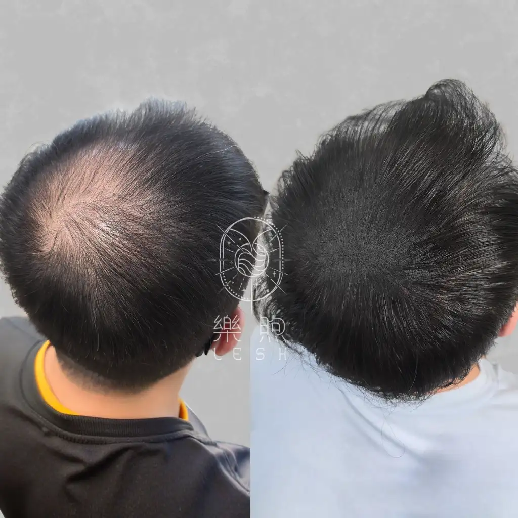 樂續SMP紋髮,後腦杓填補