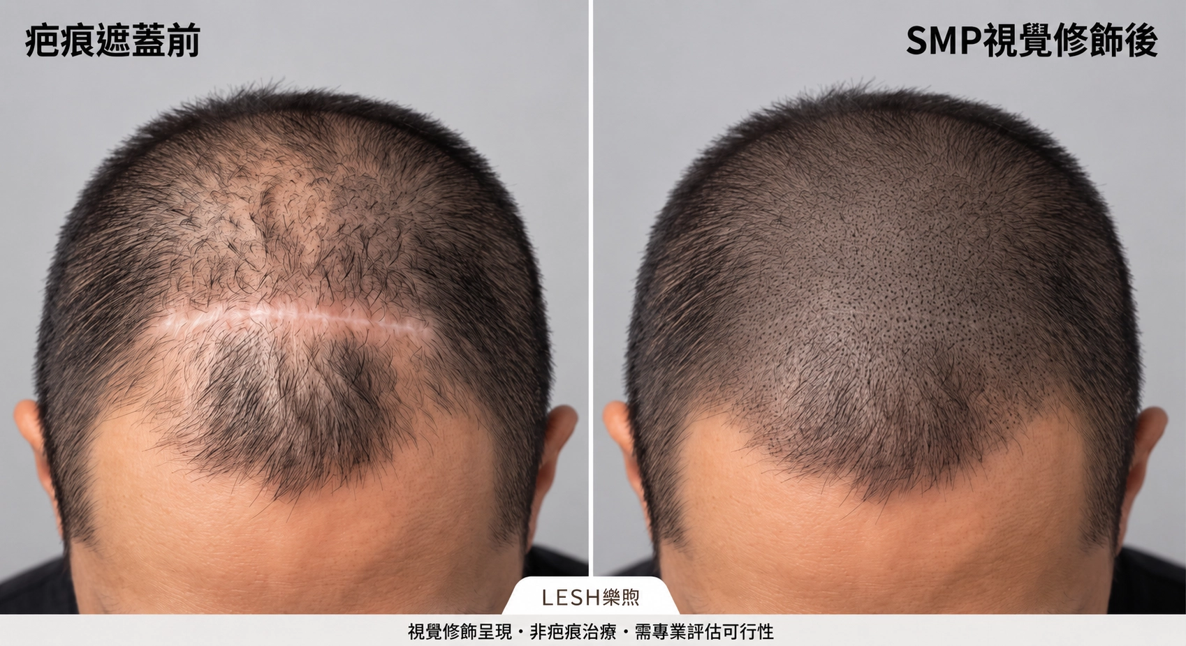 疤痕的視覺遮蓋模擬案例