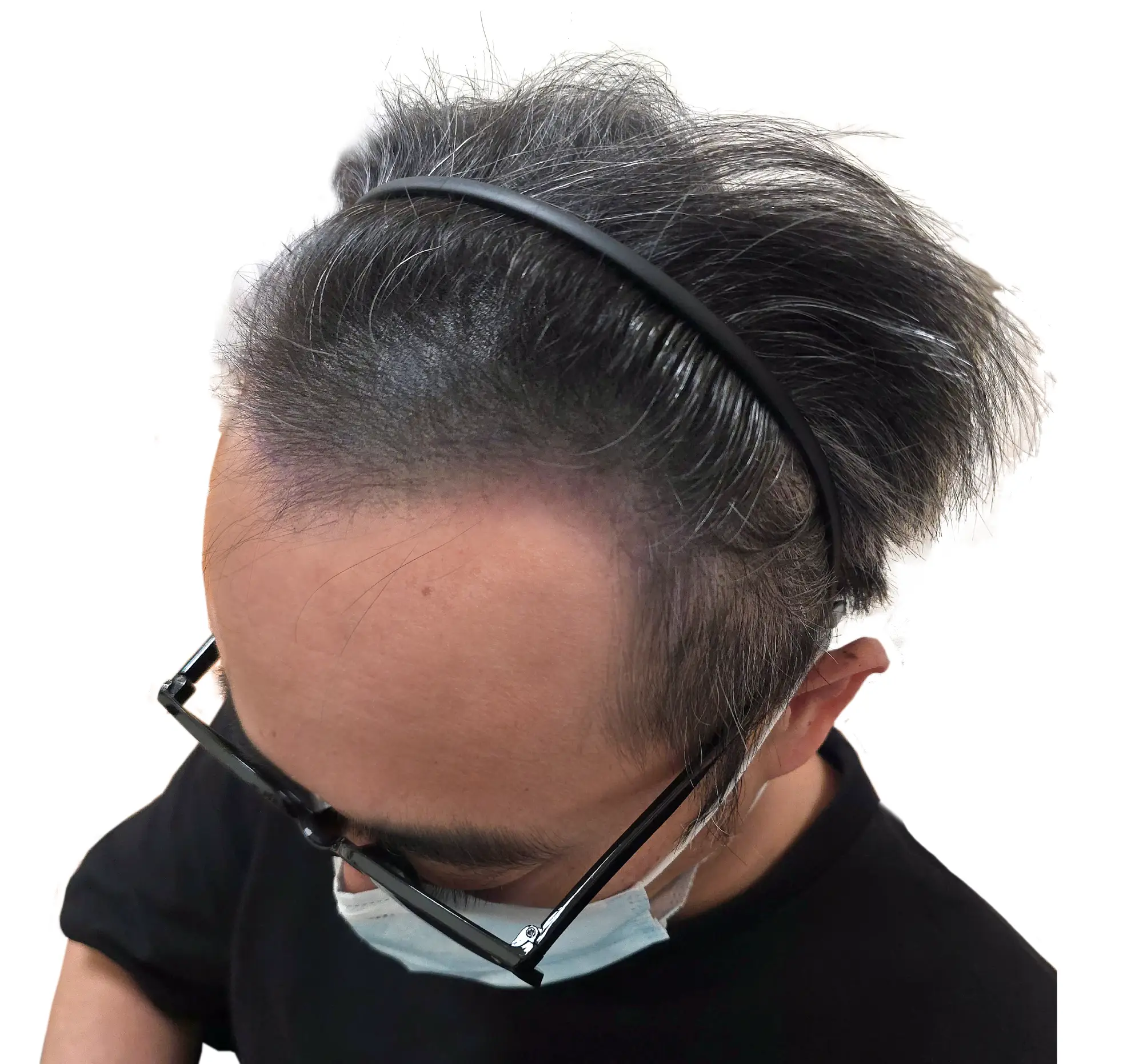 男性前髮際線修補 After (2)