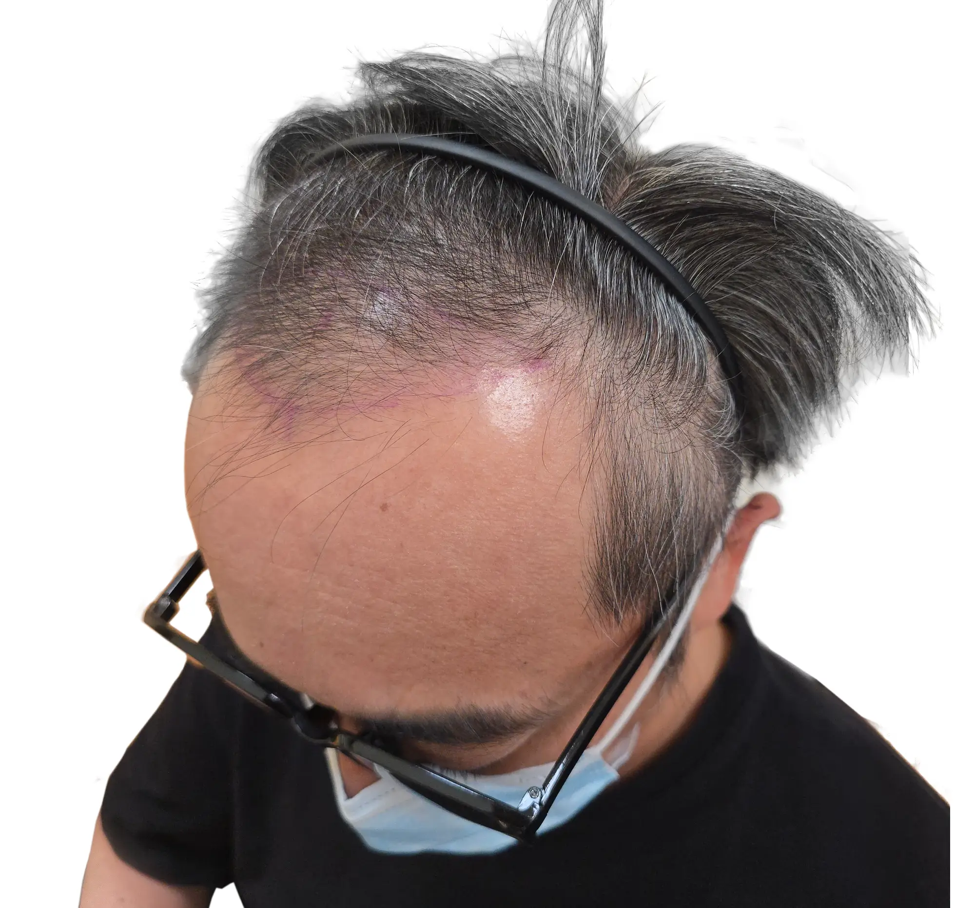 男性前髮際線修補 before (2)
