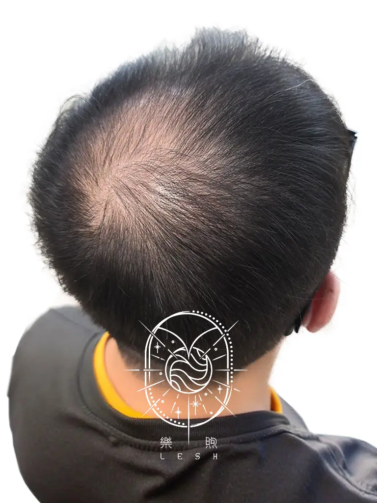樂煦頭頂紋髮_前